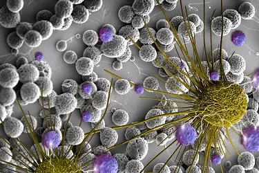 Best Hospital for treatment of stroke in gurgaon delhi india, best neurologist for stroke treatment in gurgaon delhi india, best physiotherapist for brain stroke treatment in gurgaon india, best neurologist for the treatment of stroke in india.